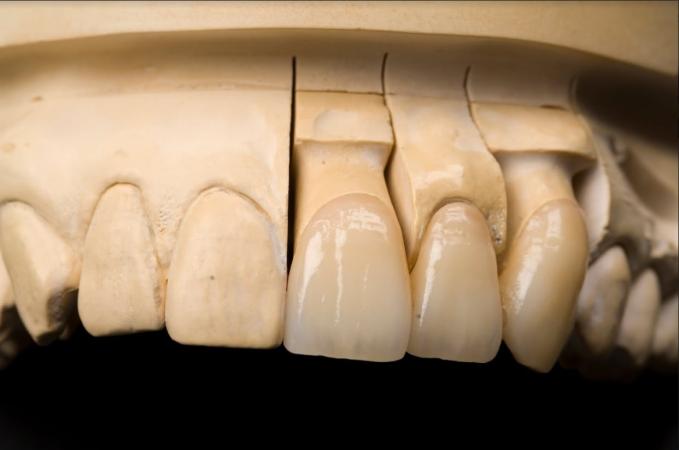 Fixed dental prosthesis includes dental restorations that are mounted to the patient's mouth.