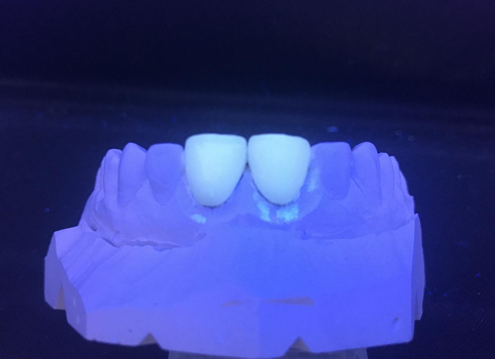 Carillas feldespaticas fluorescentes