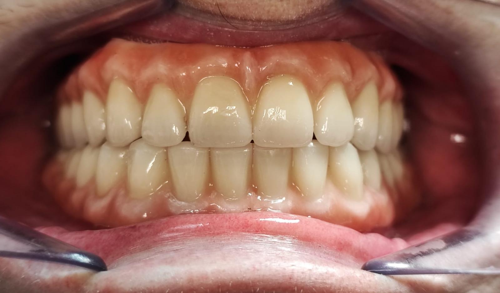 Rehabilitación sobre implantes con Zirconio. Máxima exigencia estética. Colocación en boca.